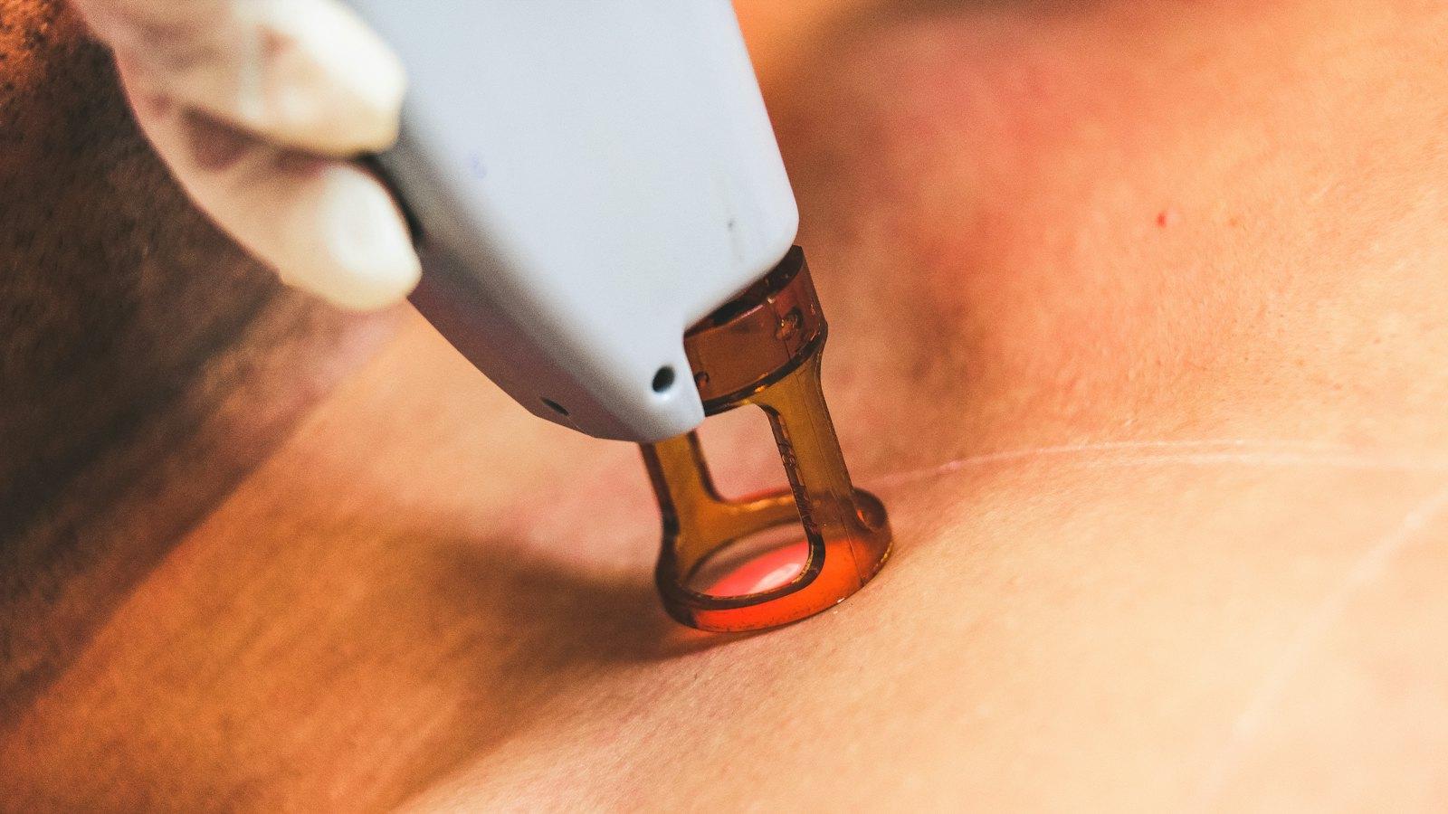 Laser Hair Removal by Area